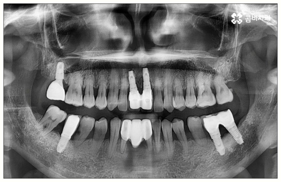 원데이임플란트 어떤가요? 관련 이미지 6