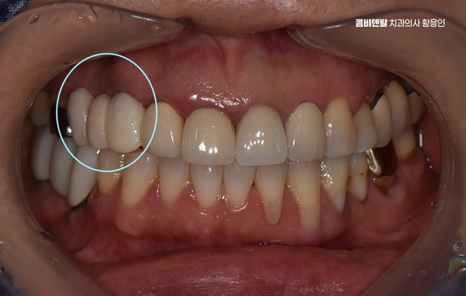 앞니 크라운 교체 깔끔하게 정리하려면 관련 이미지 1