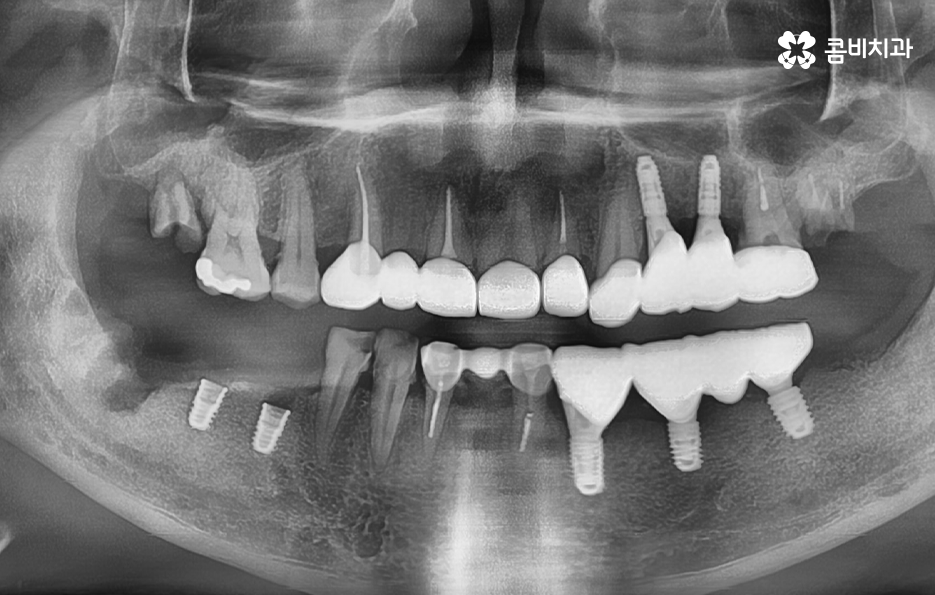 임플란트 치조골 상태에 따라 치료 계획도 달라지나요 관련 이미지 10