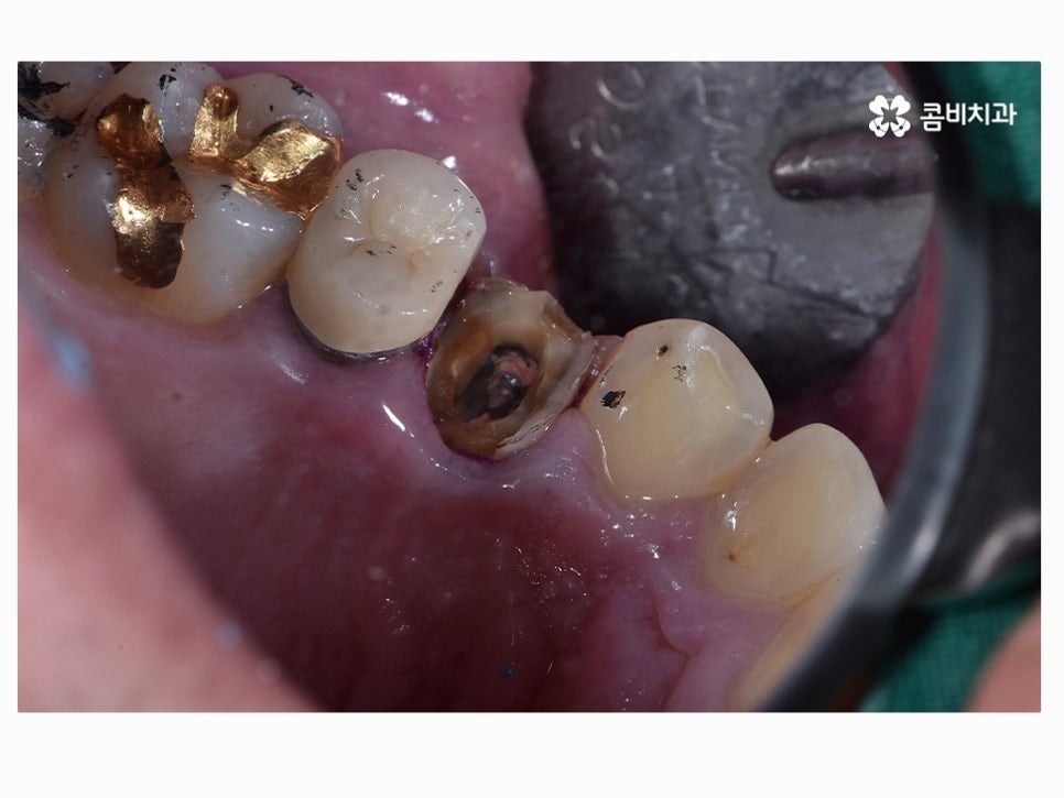 명동치과 누구나 놓치기 쉬운 문제점은! 관련 이미지 9