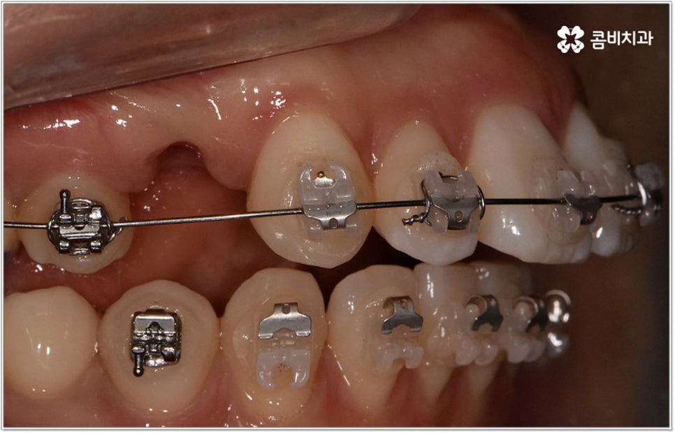 돌출입치아교정 언제가 적기인가요? 관련 이미지 4