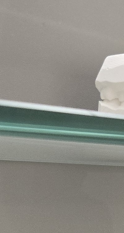 앞니 틀어짐 부분교정 얼마나 걸릴까 관련 이미지 25