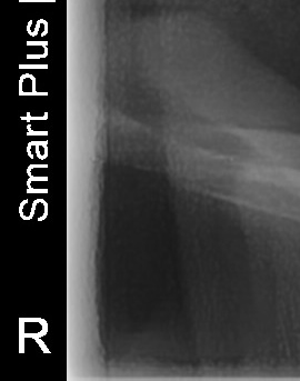 어금니 뒤 잇몸 부음 어떤 문제길래 이런거죠 관련 이미지 38
