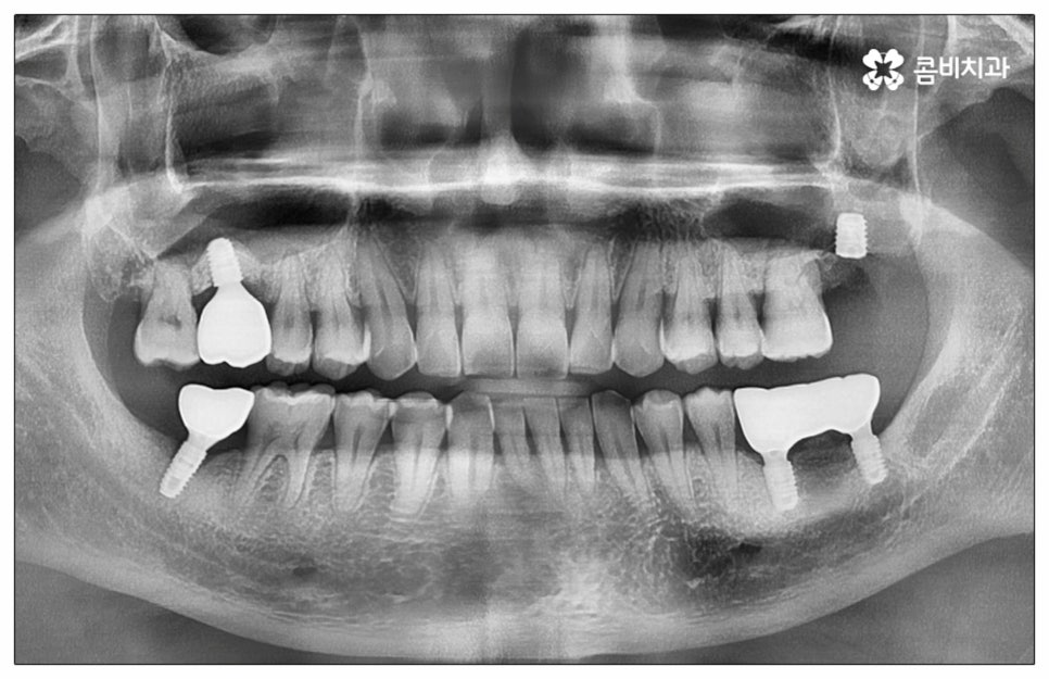 건강보험임플란트 혜택받아 보세요 관련 이미지 15