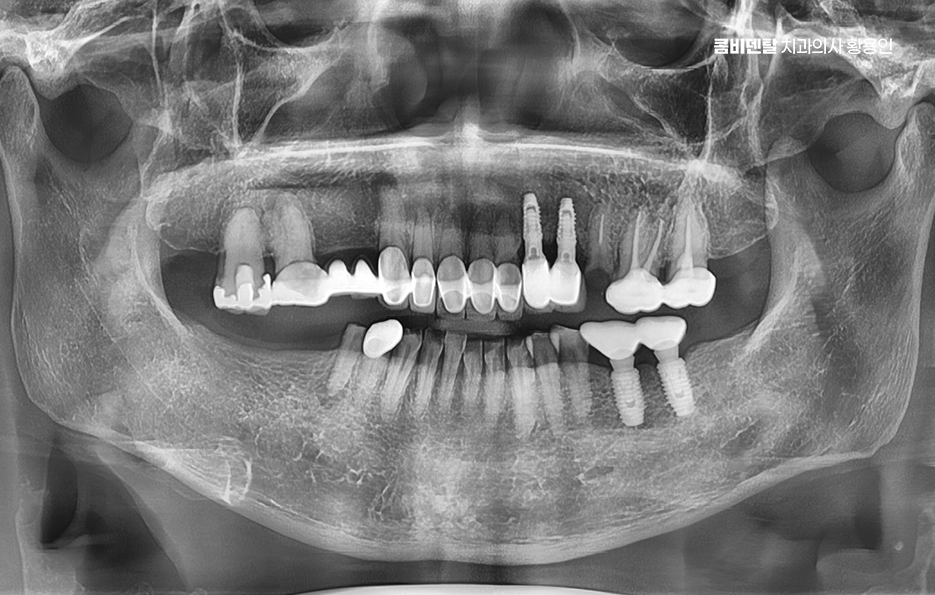 어금니 임플란트 안하면 후회하게 되는걸까 관련 이미지 1