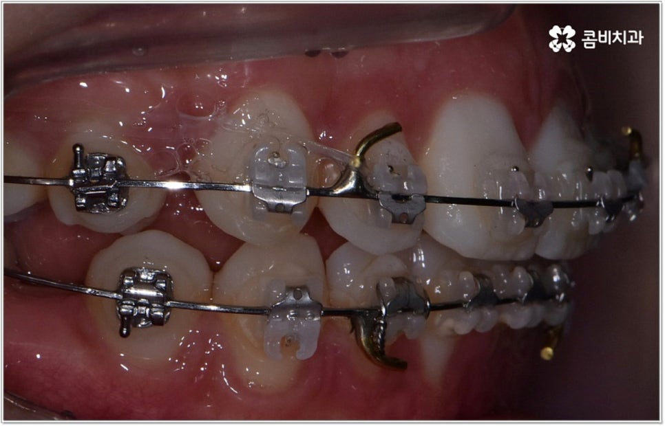 돌출입치아교정 언제가 적기인가요? 관련 이미지 7