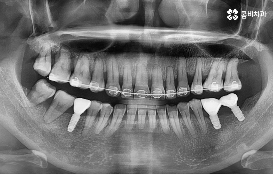 임플란트 해야 하는데 치아교정이 하고 싶다면 관련 이미지 11