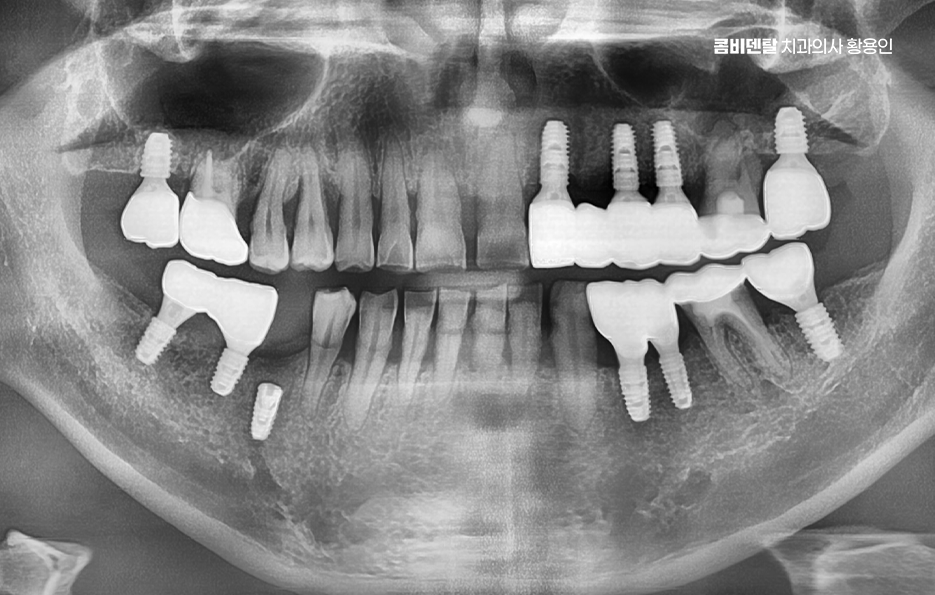 치아 발치 후 임플란트 언제부터 준비할까 관련 이미지 11