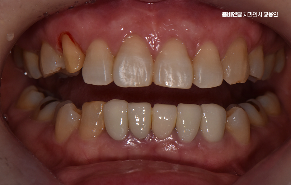 송곳니 크라운 티가 안나게 해결 가능한건가요 관련 이미지 6