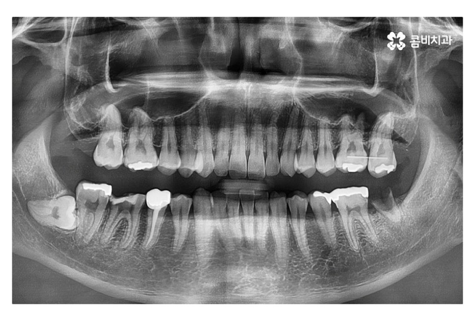 신경치료 후 크라운 시기를 놓치지 않으려면 관련 이미지 1