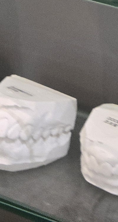 윗니 전체 임플란트 뭐부터 해야할까 관련 이미지 43