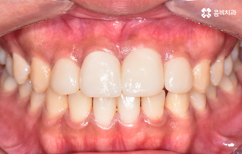 앞니만 교정 과잉치 뽑아서 해결했어요 관련 이미지 11