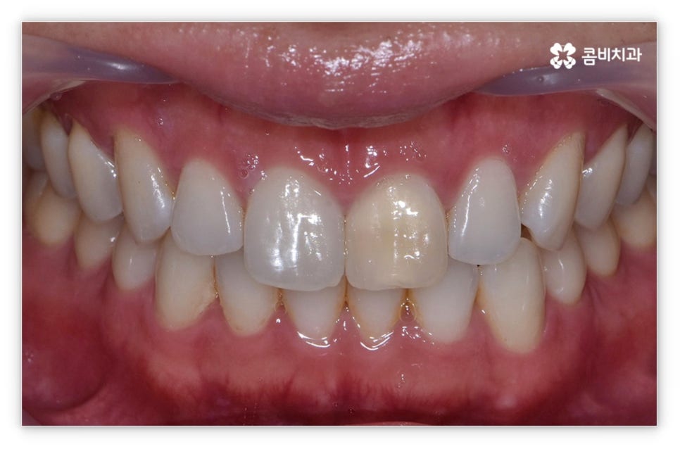 앞니설측교정 망설여질때는 관련 이미지 3