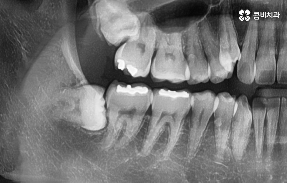 어금니 충치치료 깔끔하게 해결하려면 관련 이미지 5