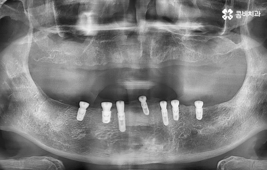 전체임플란트 어떤 방식으로 해야하나요 관련 이미지 6