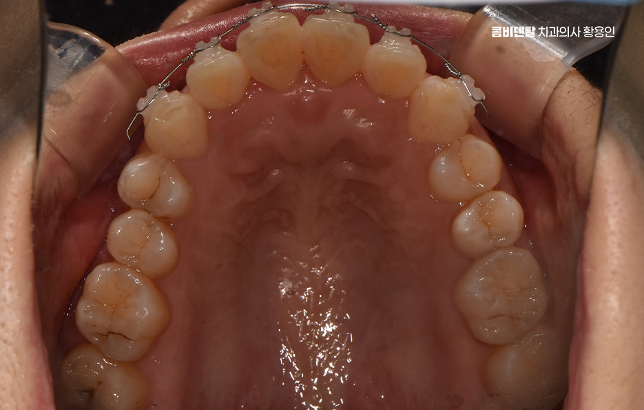 앞니 부분 교정 간단하니까 좋은건가요 관련 이미지 10