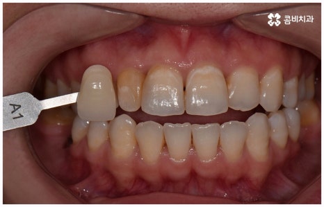 임플란트 종류 어떤게 맞을까요? 관련 이미지 11