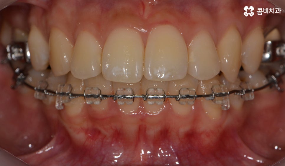 콤비교정 나에게 적합한지 판단하려면 관련 이미지 7