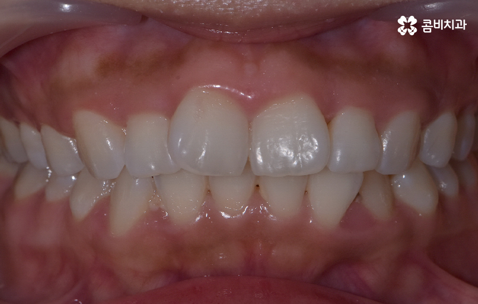 앞니 틀어짐 교정 방법 이럴때는 좀더 간단해요 관련 이미지 2