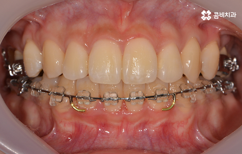 콤비교정 나에게 적합한지 판단하려면 관련 이미지 11