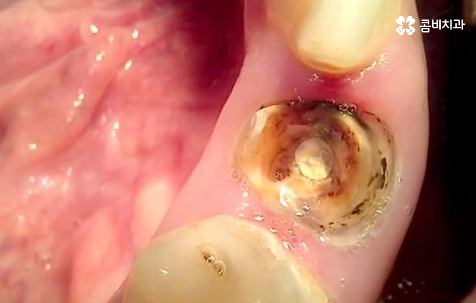 충치 단계 어떻게 분류하고 치료해야 하나요 관련 이미지 2