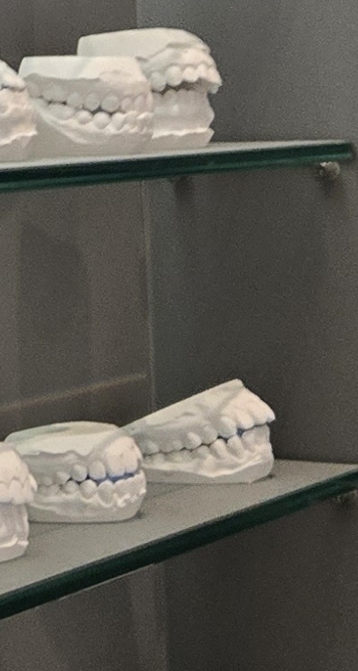 완전매복사랑니 발치 대학병원 꼭 가야하나요 관련 이미지 35