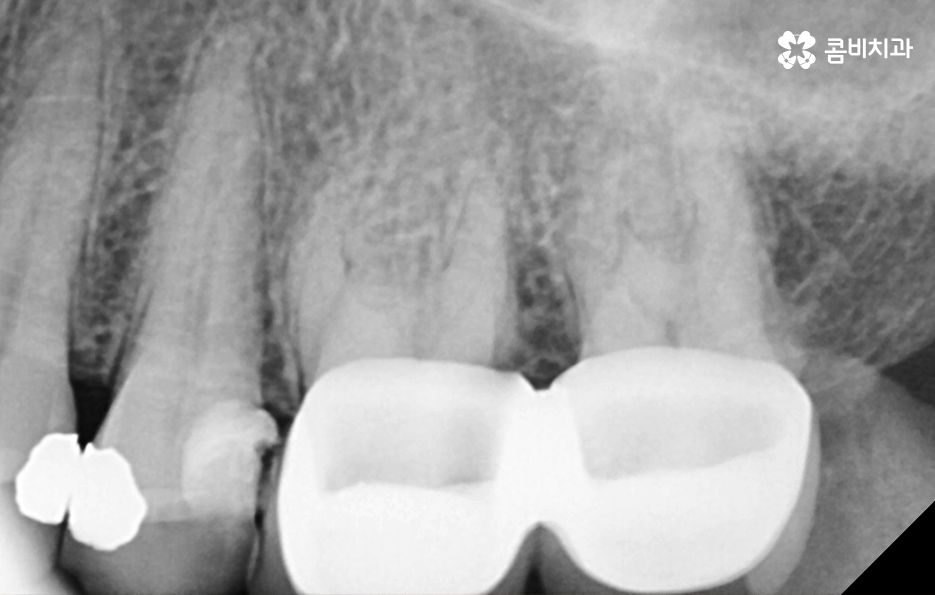 명동치과 놓치기 쉬운 2차충치에 주의하려면 관련 이미지 8
