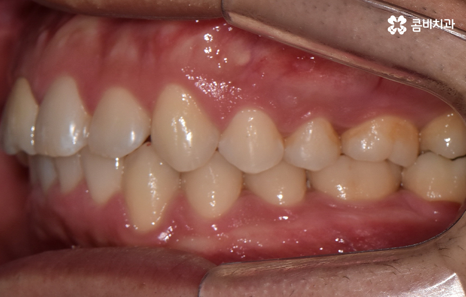 아랫니교정 이렇게만 파악하시면 됩니다 관련 이미지 14