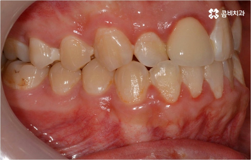 덧니교정 하고싶다면 관련 이미지 2