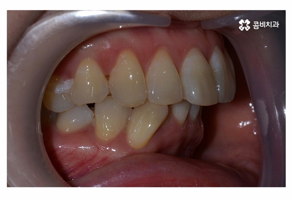 치아설측교정 가능한지 궁금하다면 관련 이미지 2