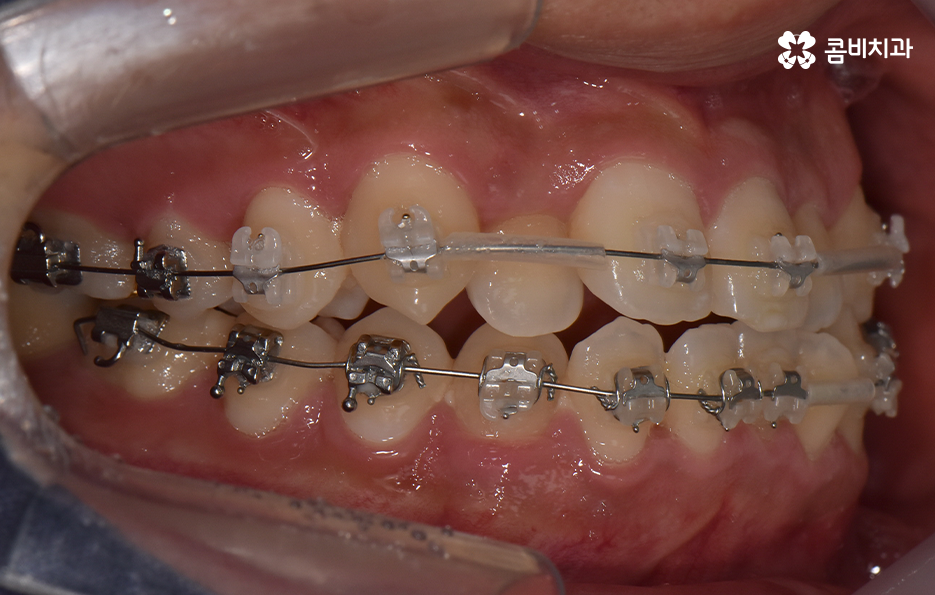 30대 치아교정 빨리 끝내고 싶어요 관련 이미지 7