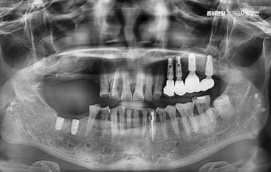 어금니 임플란트 과정 제대로 이해하려면 관련 이미지 5