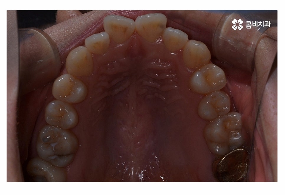 치아부분교정 나도 해당될지 궁금하다면 관련 이미지 3