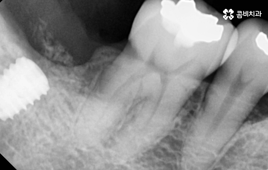 임플란트 치료기간 어느정도 걸리고 치과에는 몇번 가나요 관련 이미지 5