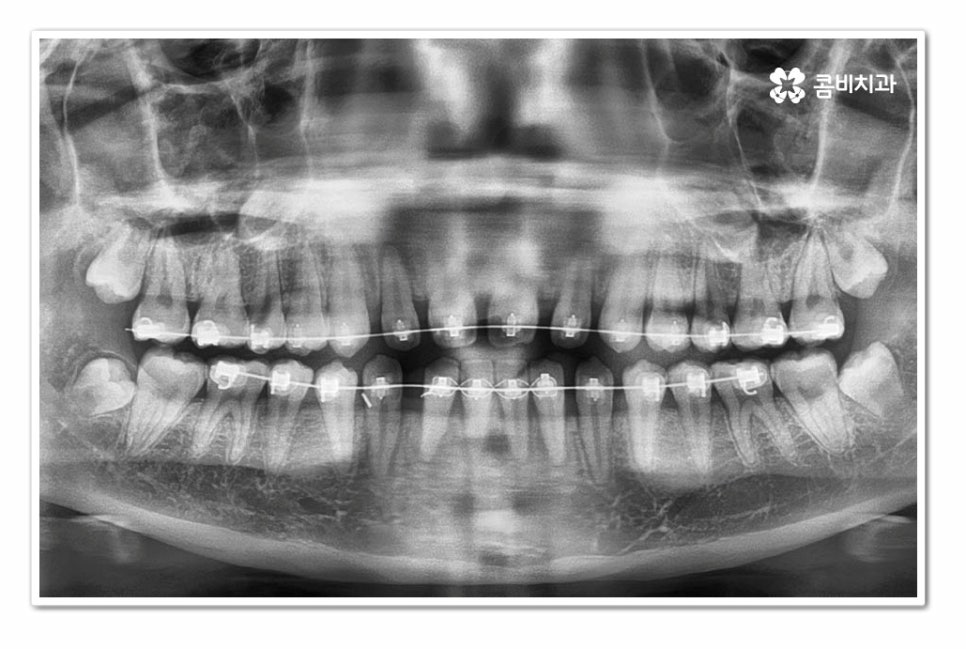앞니 벌어짐 똑똑하게 해결하려면 관련 이미지 7