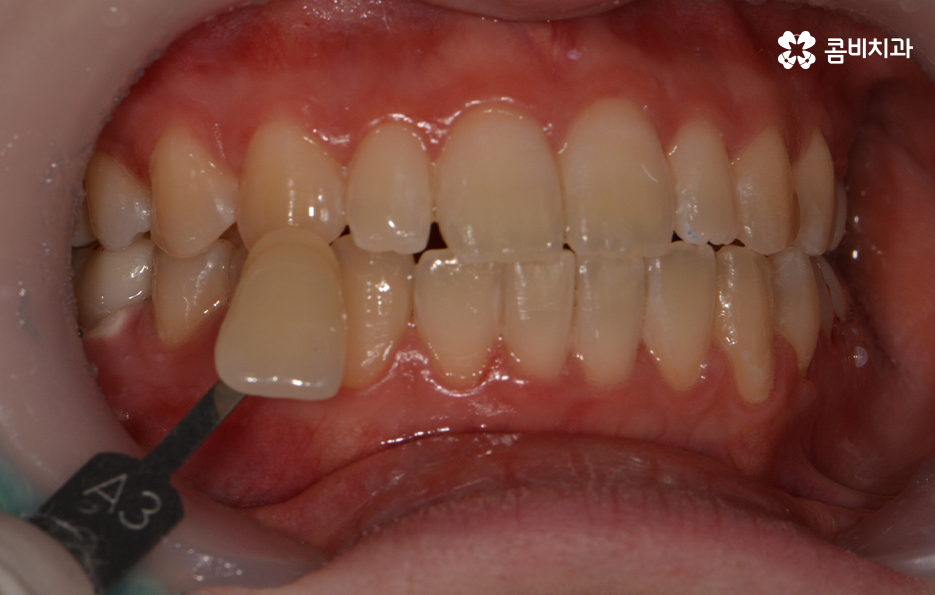 치과치아미백 어떻게 다른지 설명해드려요 관련 이미지 4