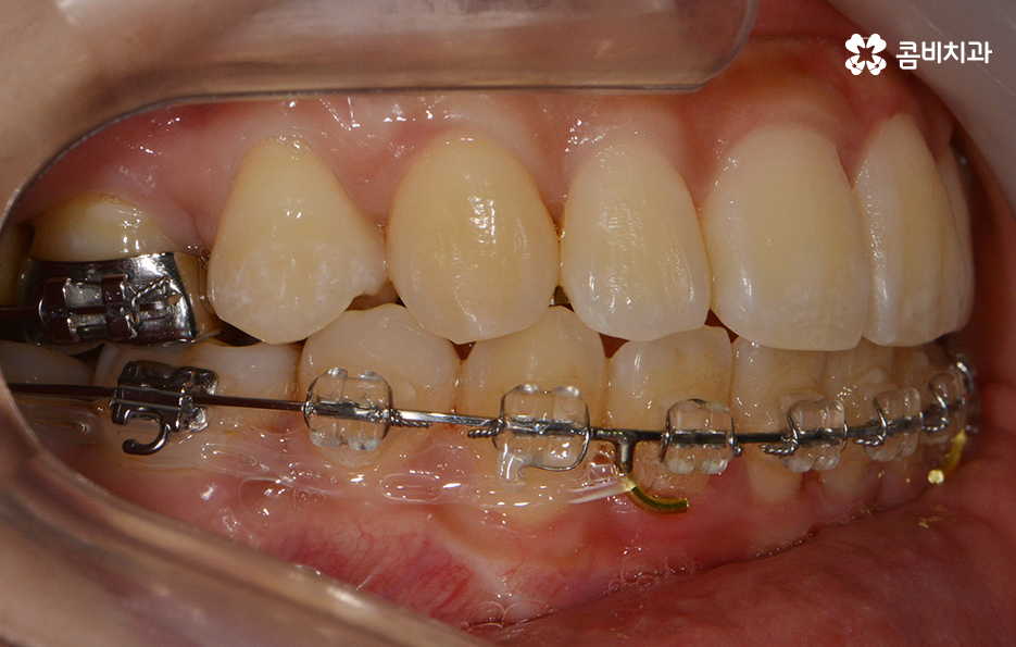 콤비교정 나에게 적합한지 판단하려면 관련 이미지 12