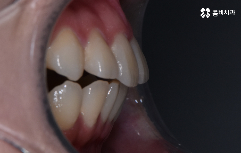 아래앞니 벌어짐 교정으로 해결했어요 관련 이미지 2