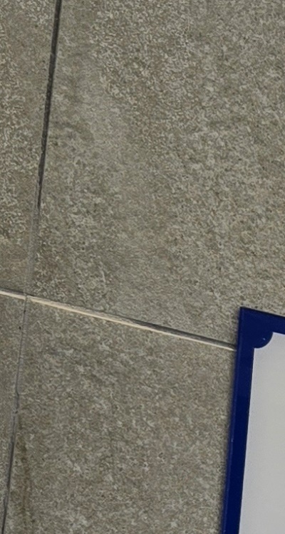 앞니 신경치료 크라운 까지 해야할 상황이라면 관련 이미지 23