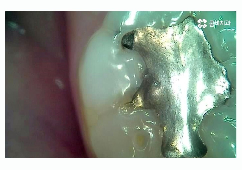 충치 떼우기 스무살이후에 조심해야 할 점은? 관련 이미지 1