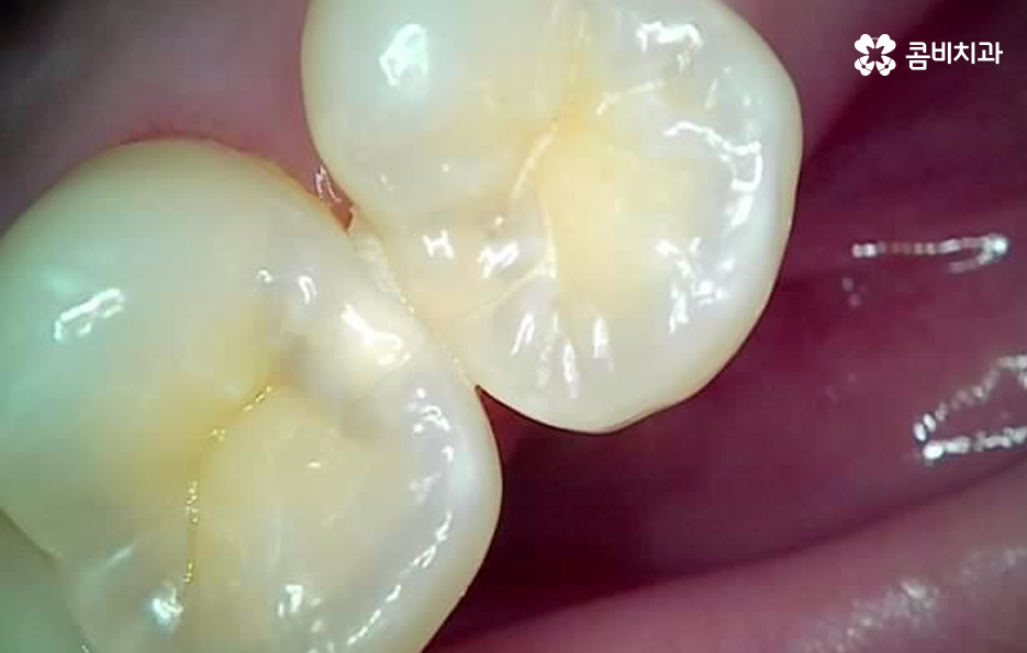 충치 신경치료 안하면 후회하는 이유 관련 이미지 3