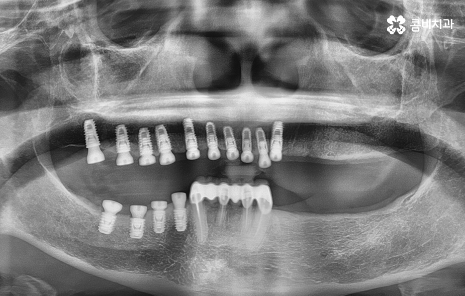 65세이상임플란트 고령이기에 간과하지 말아야 할 사항은 관련 이미지 4