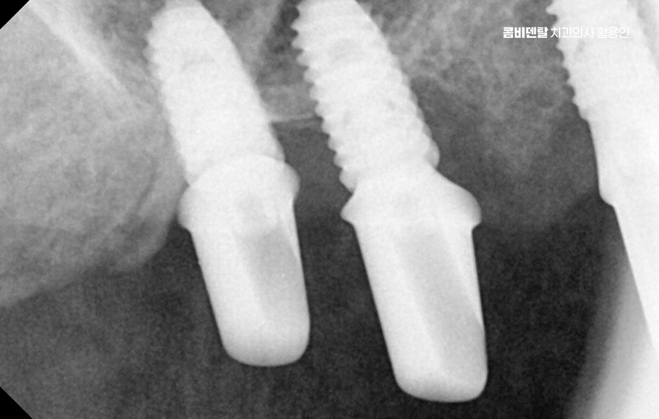 If You’re Considering Full Upper-Arch Implants for the Long Term image 9