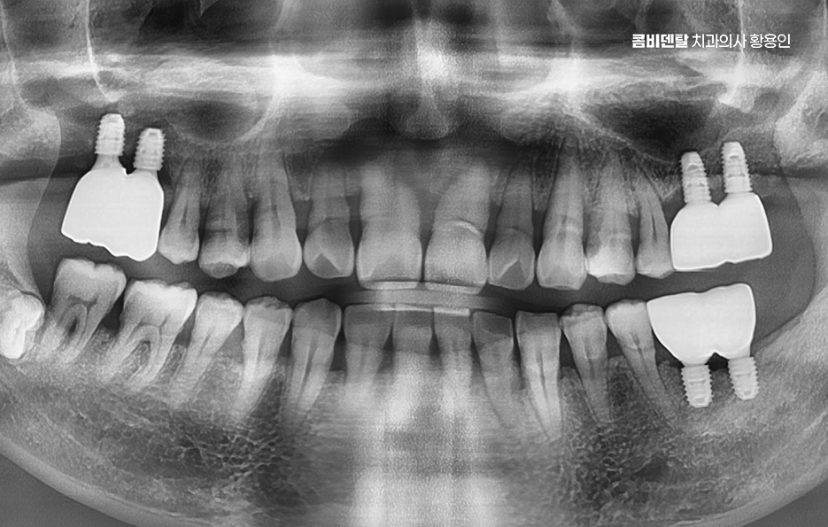 어르신 임플란트 지원 현명하게 활용하려면 관련 이미지 10