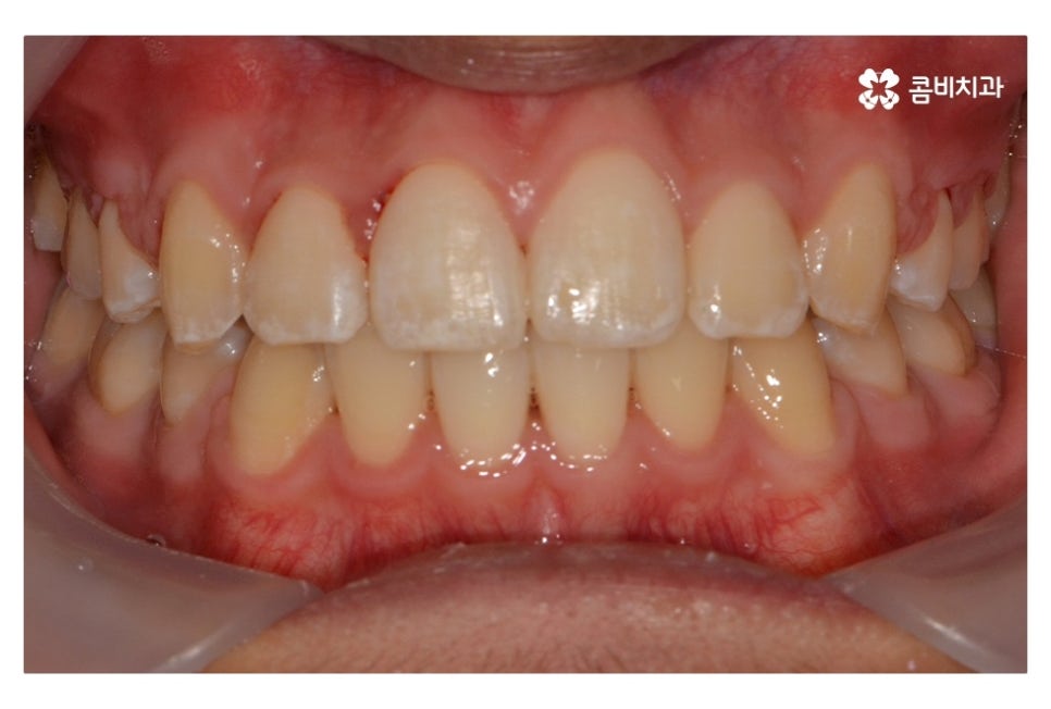 중학생치아교정 세심하게 체크하려면 관련 이미지 14