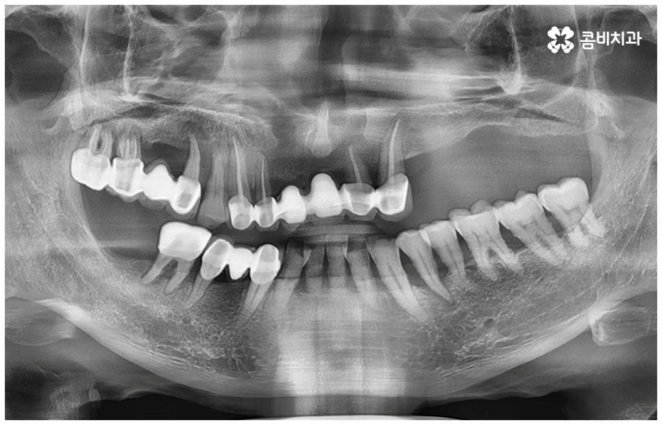 임플란트수명 연장하려면? 관련 이미지 1