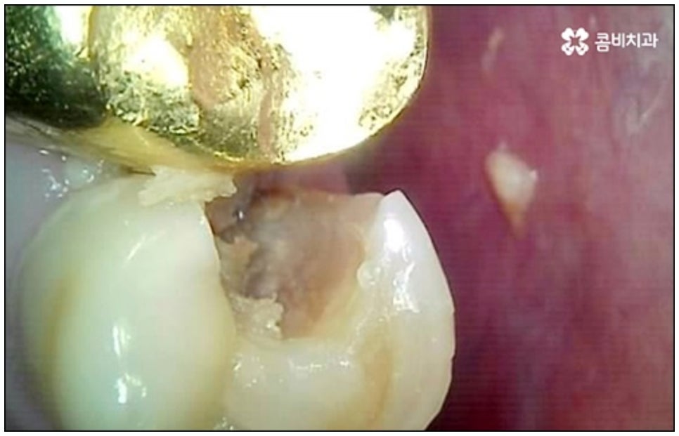 당일임플란트 나도 할수있나요 관련 이미지 8