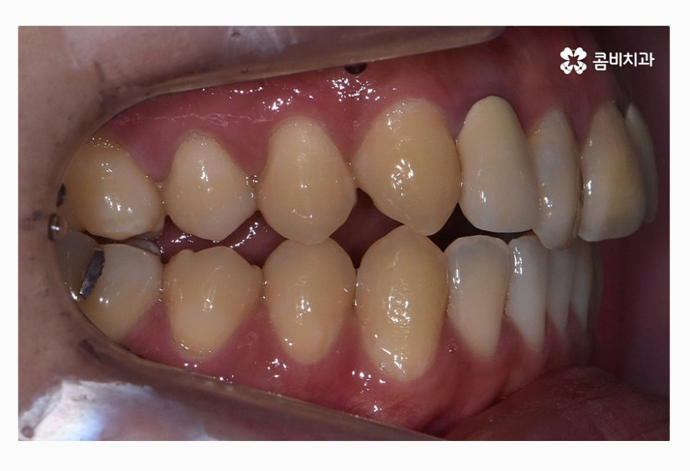 콤비교정 올바르게 판단하려면 관련 이미지 2