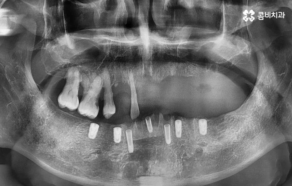 전체임플란트 어떤 방식으로 해야하나요 관련 이미지 4