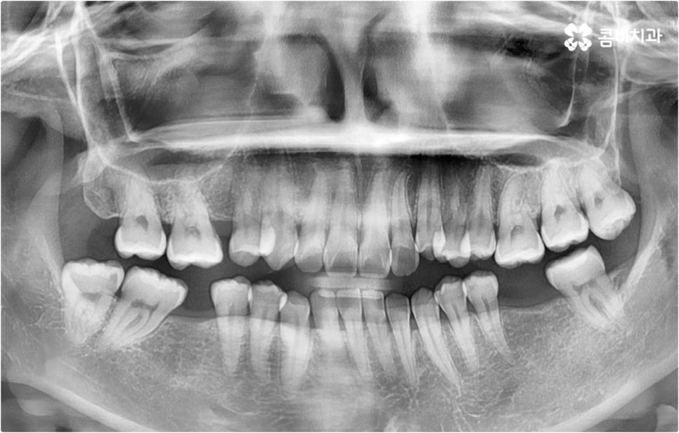치아설측교정 보이지않아 좋아요 관련 이미지 10